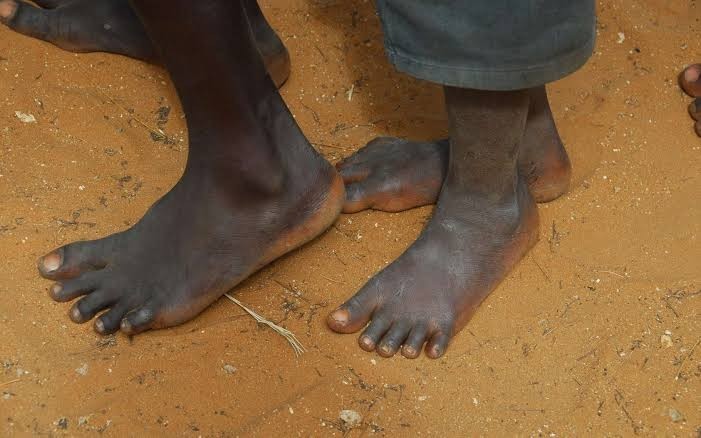 Faites-vous attention à la santé de vos pieds ? Voyez pourquoi vous devriez...