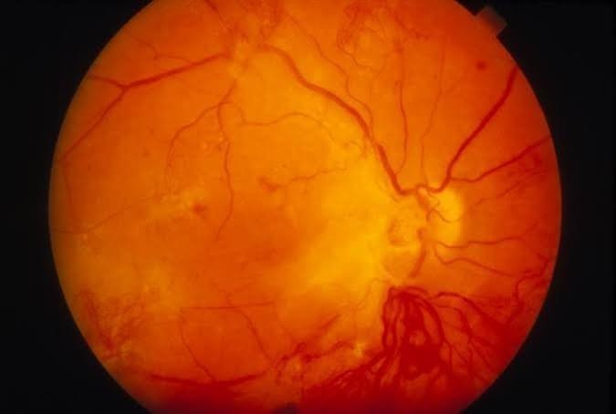 Le dépistage de la Retinopathie Diabétique, une lutte pour la vue