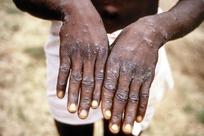Présente en RDC, l’épidémie de MPOX déclarée par l’OMS une urgence de santé publique mondiale
