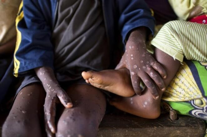 RDC : 23 des 26 provinces du pays touchées par le Monkey Pox, plus de 50 décès enregistrés