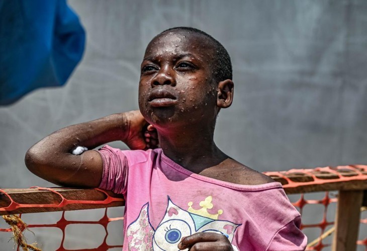 RDC : L'exécutif débloque un fonds d’au moins 6 millions USD pour faire face à l’épidémie de Mpox