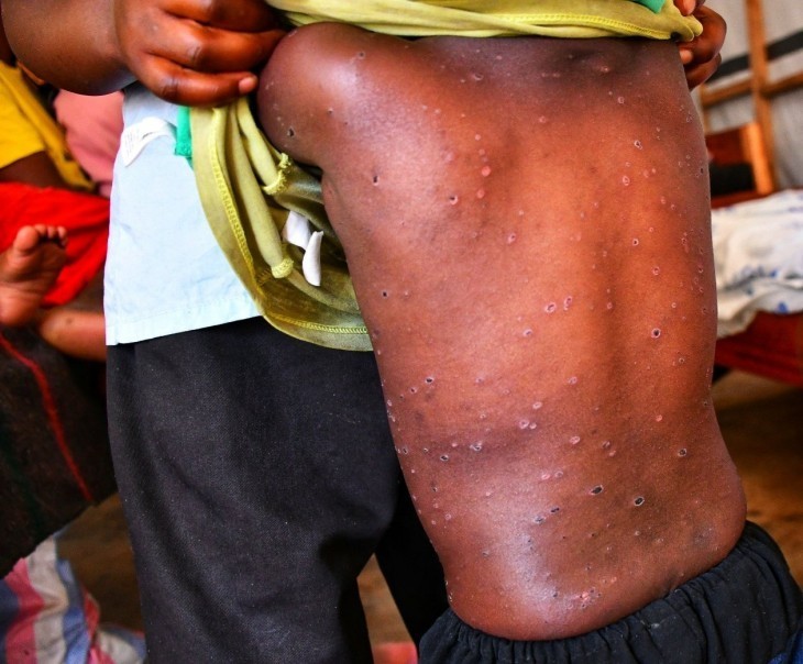 Rien que pour la vaccination, la RDC a besoin de 600 millions USD pour faire face au MonkeyPOX