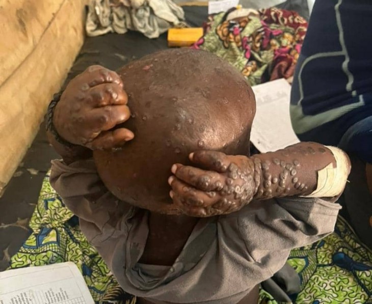 RDC : Le gouvernement note une tendance à la réduction de la létalité de l’épidémie de MonkeyPox