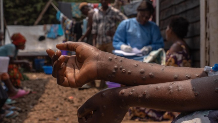 RDC: Plus de 64.000 cas de MPox enregistrés entre 2023 à 2024 avec une baisse de la létalité à 2,1%